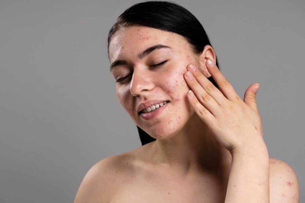 A woman with acne on her face.