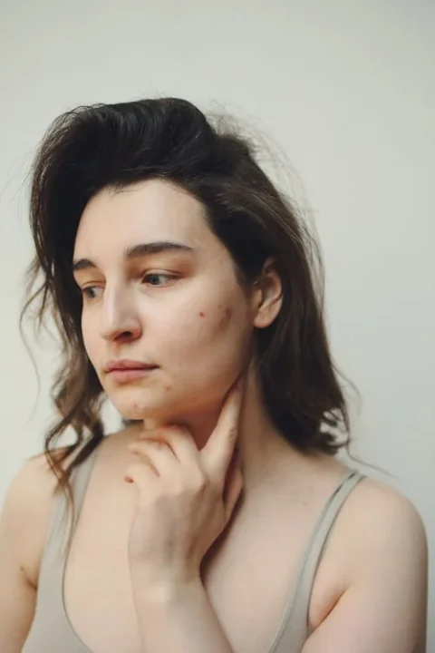a girl with visible skin blemishes, which appear to be acne.